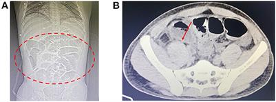 Acute mesenteric ischemia following lancehead snakebite: an unusual case report in the Northernmost Brazilian Amazon